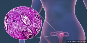 Unaí oferecerá exame molecular gratuito para prevenção do câncer de colo do útero